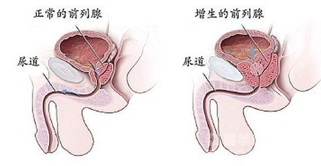 前列腺增生 (2).jpg